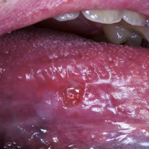 oral cancer tongue