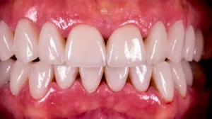 thin gums